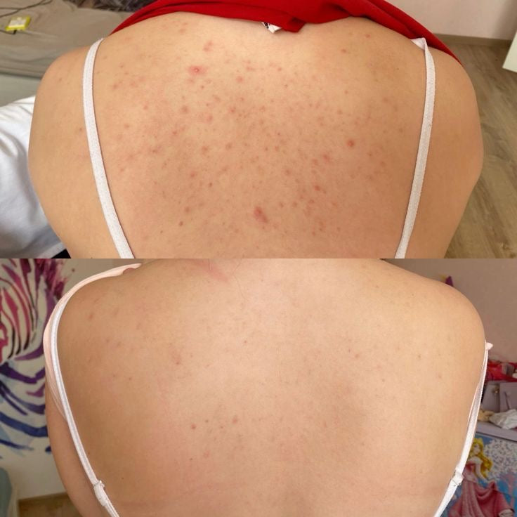 Luffa Akne Rücken Schwamm